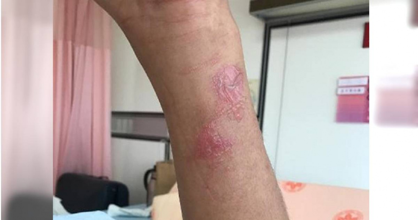蜂螫旺季到!戶外避穿鮮豔服飾噴香水 超過20處傷口恐中毒身亡